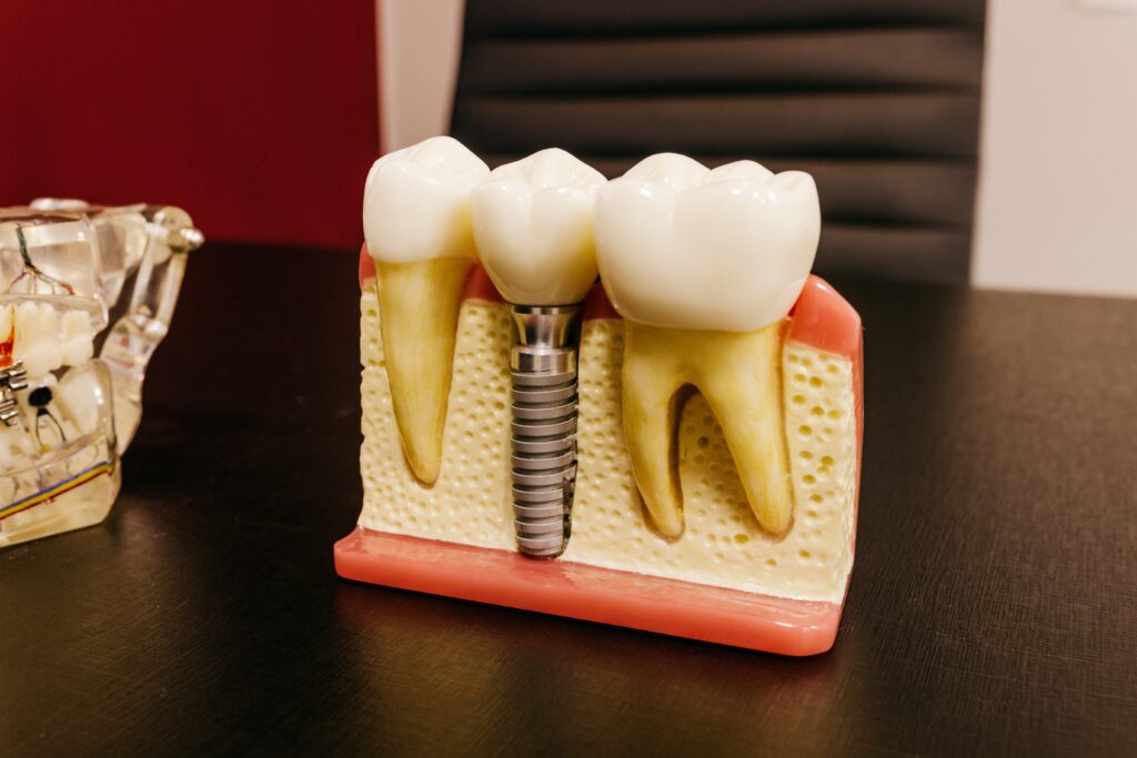 Dental Implant - Burki Dental DHA Karachi