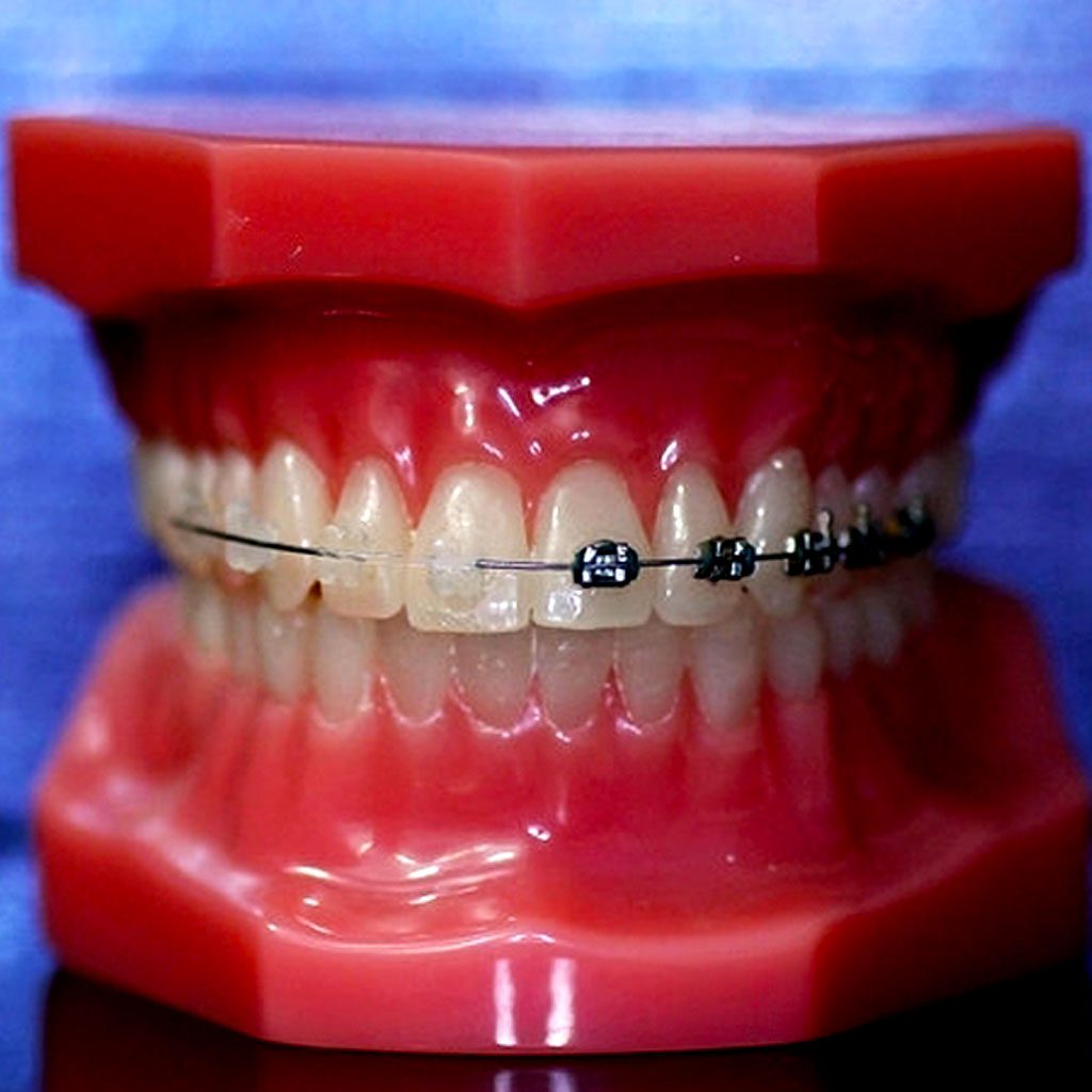 Braces and Clear Aligners in Karachi Straighten Your Teeth with